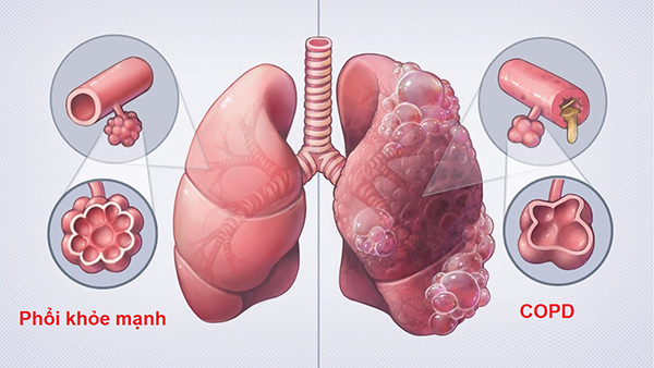 bệnh phổi tắc nghẽn mạn tính